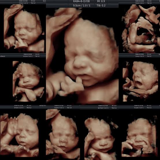 Growth Scan Ultrasound in Pregnancy